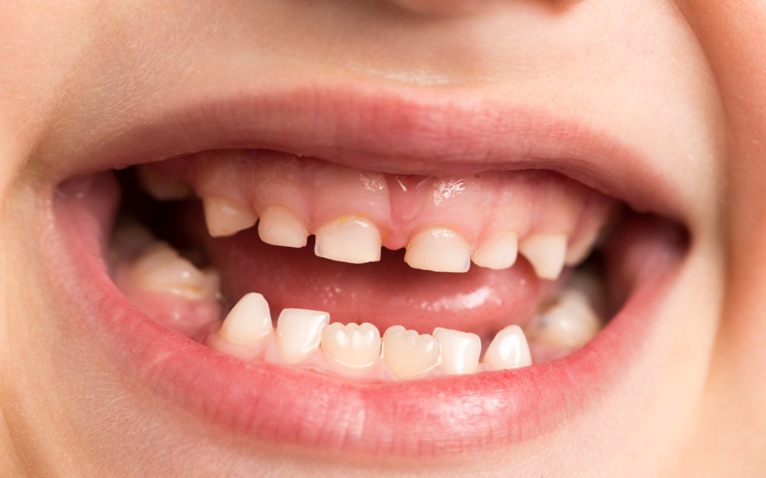 I denti da latte cariati vanno curati?