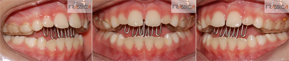 Caso Ortodonzia intercettiva 1