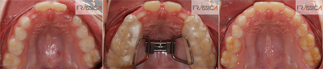 Caso Ortodonzia intercettiva 2