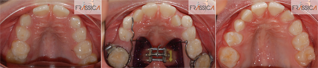 Caso Ortodonzia intercettiva 3