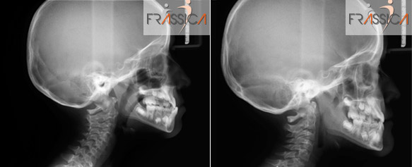 Caso Ortodonzia intercettiva 4
