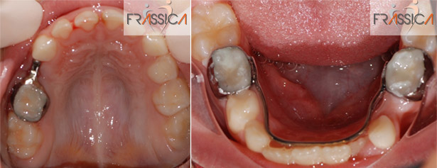 Caso Ortodonzia intercettiva 5