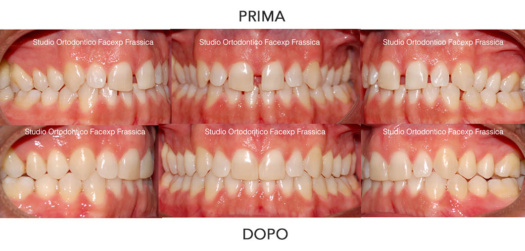 Diastemi