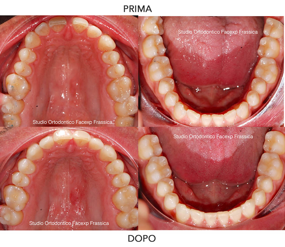 Diastemi